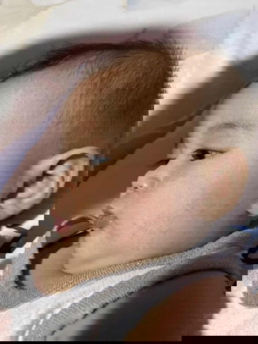 Rashes in bb face