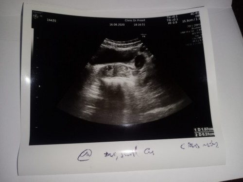 เจอถุงการตั้งครรภ์