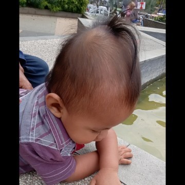 Kepala anak sejak bayi benjol seperti siput