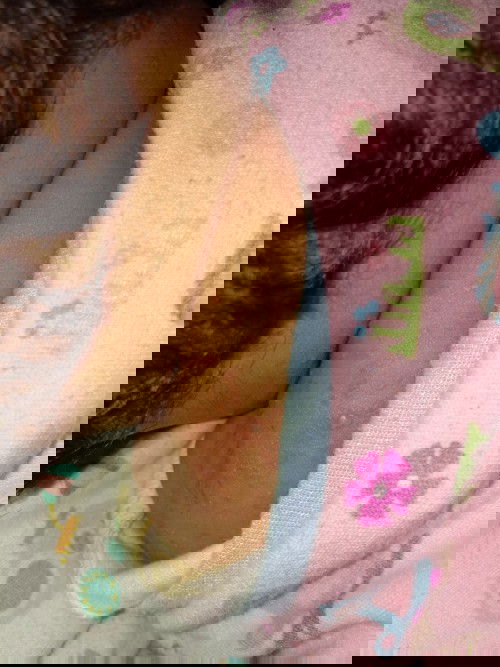 bintik merah dikulit