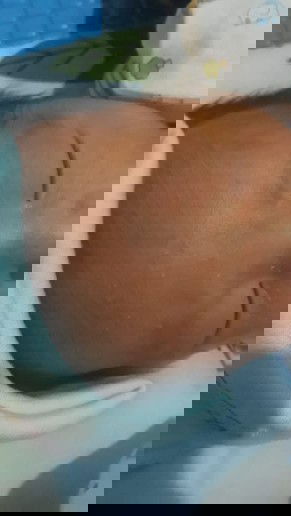 jerawat bayi & pusar