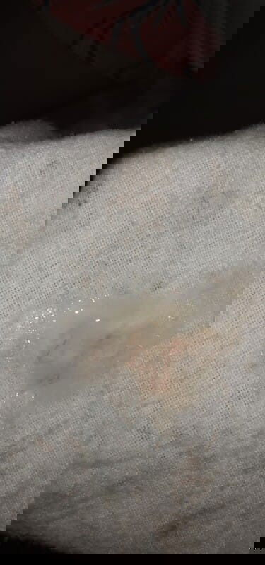 ท้อง38wมีอาการปวดท้องทุก10นาทีท้องปั้นตลอด