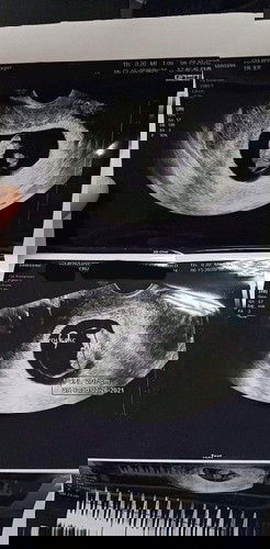 Heartbeat at 9 weeks ♥️