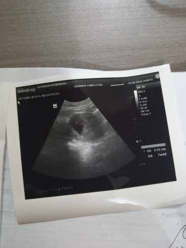 Blighted ovum