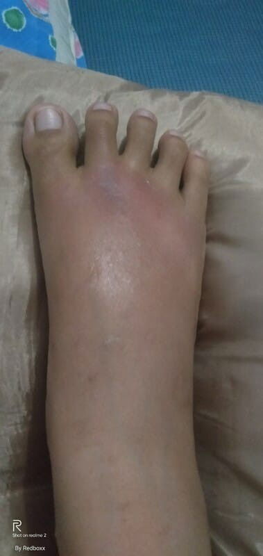 Hamil 14w persendian kaki an tangan nyeri, ngilu dan panas.