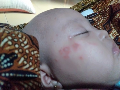 bintik-bintik merah berair pada anak