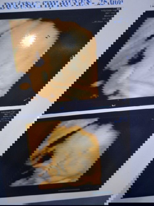 Cân nặng thai nhi