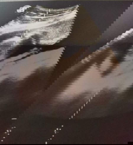Ultrasound at 14weeks