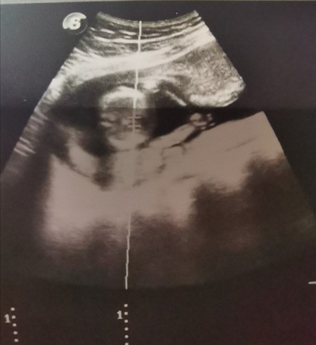 Ultrasound at 14weeks