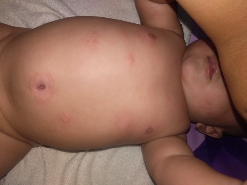 kuliat bayi merah kasar yang mengelupas