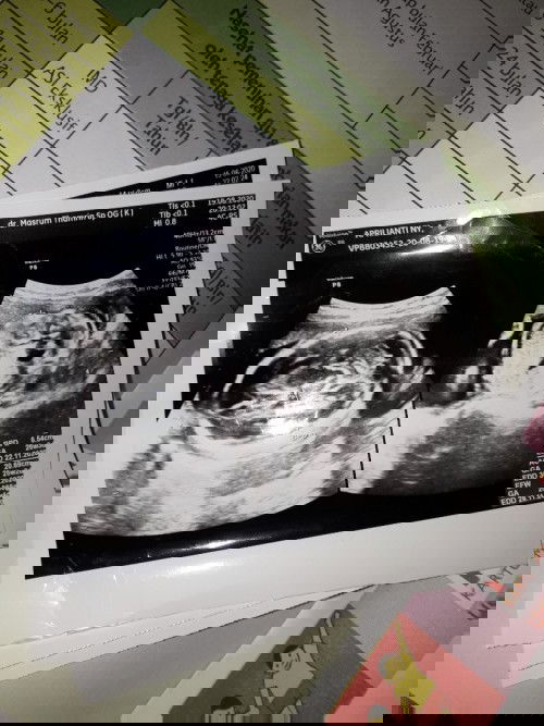 cara mengatasi janin sungsang