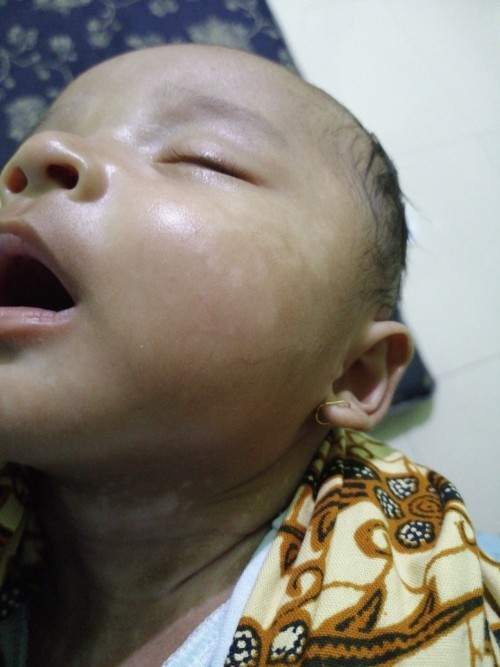Bekas ruam