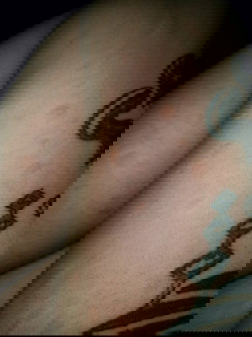 Rashes while pregnant.