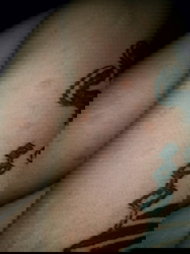 Rashes while pregnant.