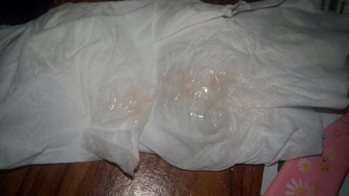 คืออะไร เป็นเมือกๆ มีสีติดเลือดนิดๆ