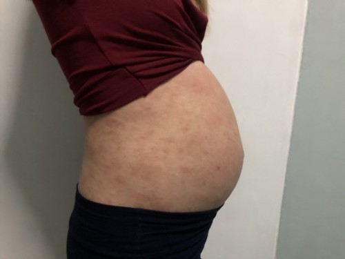 Horrible full body rash, how long it is going to take to recover😫