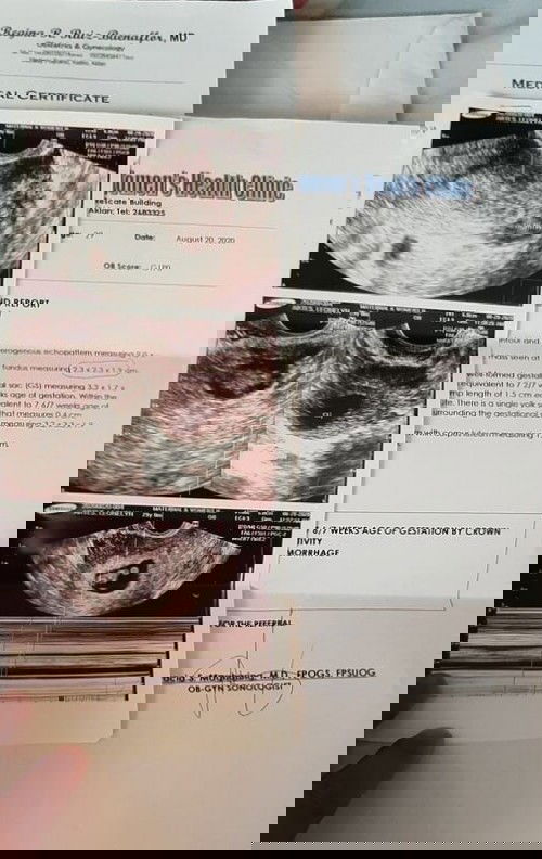 I have a minimal-moderate subchorionic hemmorhage while on my 7weeks 6 days