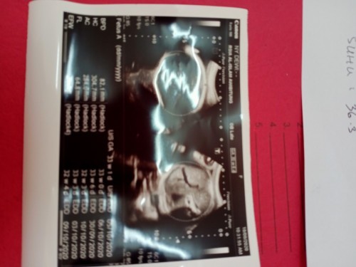 Hamil dengan placenta previa