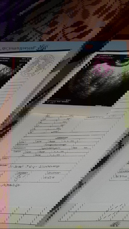 Ini janin atau kantung ya bunda?