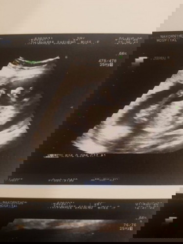 คุณหมอบอกว่าลูกสาว 100% ค่า แถมยังชี้ลูกศรให้ดูด้วย แต่แม่ดูไม่ออก555 ช่วยบรรยายหน่อยไหนมั้ยคะ☺️