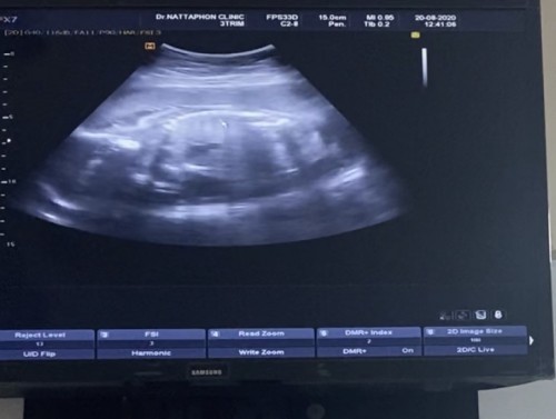 สอบถามประสบการณ์แม่แม่หน่อยค่ะ