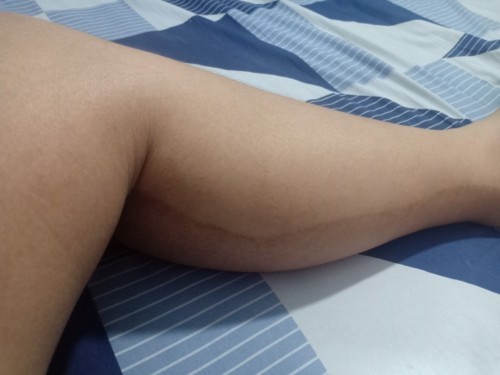 แม่ๆท่านใดตั้งแต่ท้องมีเส้นดำขึ้นที่ด้านหลังขาบ้างคะ