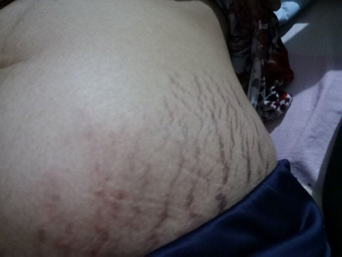 STRETCH MARKS at 31 WEEKS