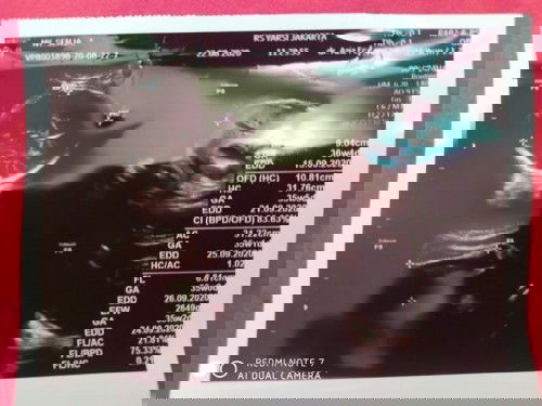 Usia Lingkar Kepala dan Perut Janin berbeda.