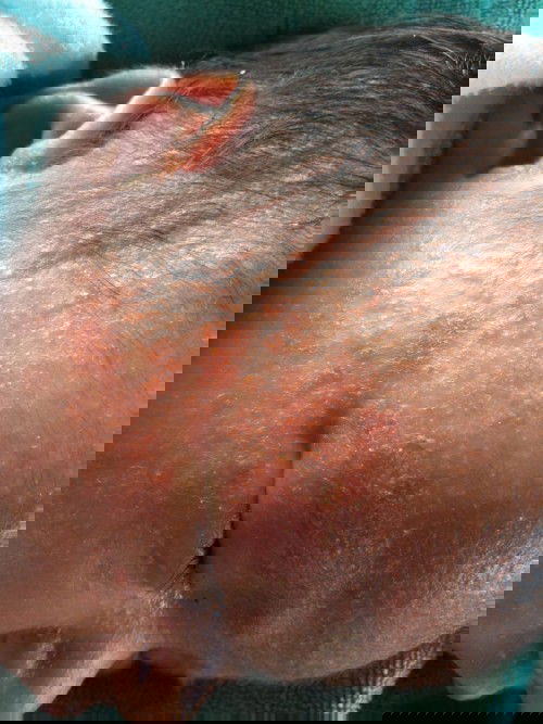 น้องมีผื่นขึ้นที่หน้าเป็นมาได้23วันเเล้วหน้าน้องเเห้งเเละลอกจะทำไงค่ะ