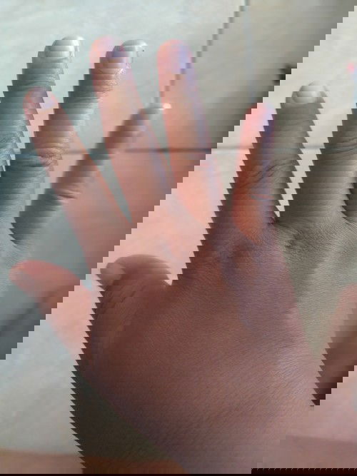 tangan dan kaki bengkak