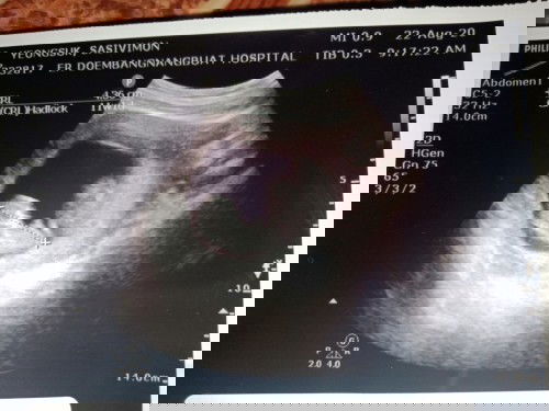 ท้อง3หลังจากเสียน้องไป3เดือนกว่า