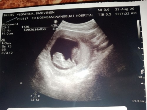 ท้อง3หลังจากเสียน้องไป3เดือนกว่า