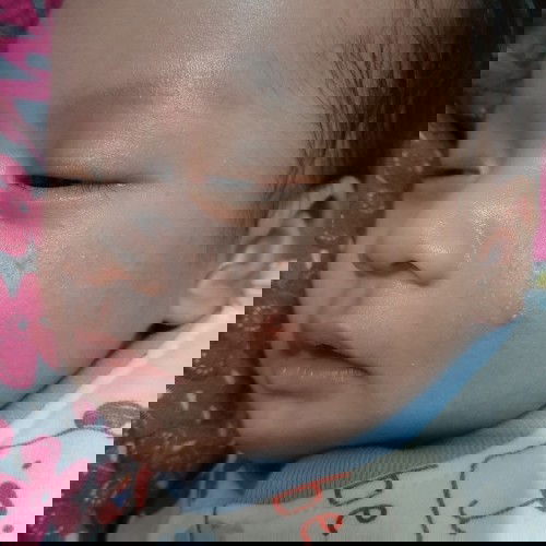 ruam pipi seperti jerawat