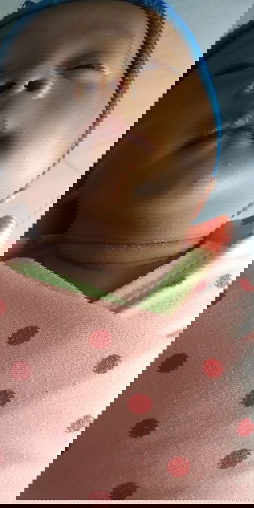 Menghilangkan Ruam Susu