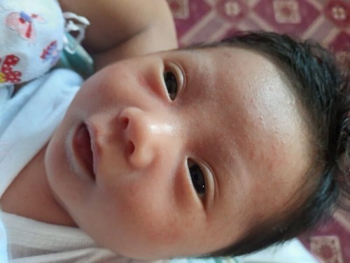 Baby Acne