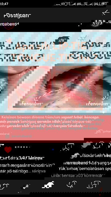 LIP TIE / TONGUE TIE