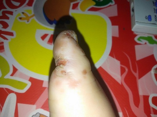 Jempol kaki kering dan merah