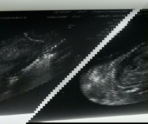 อัลตร้าซาวด์ อายุครรภ์6สัปดาห์2วัน