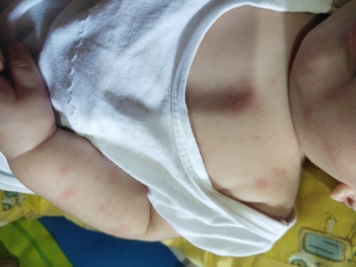 Baby body rashes