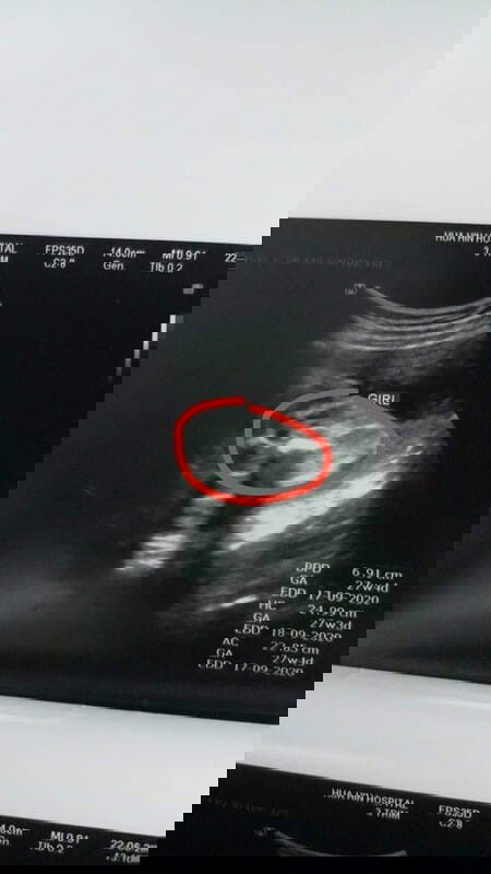 ซาวด์เพศลูก !!!