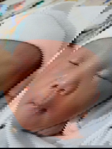 Butlig around eyes