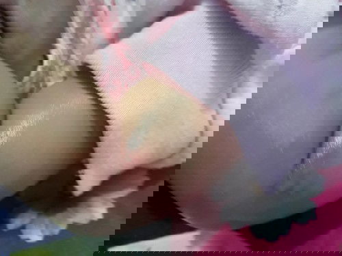 gatal2 karena kelebihan protein