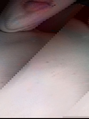 Pls Help!! Rashes under my Breast & Chest