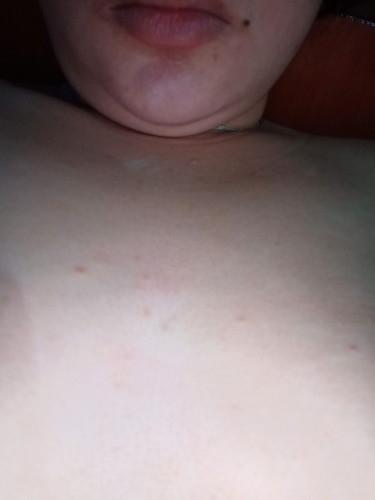 Pls Help!! Rashes under my Breast & Chest Anyone experience