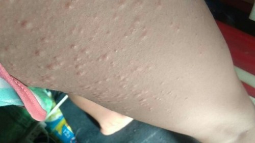 Rashes