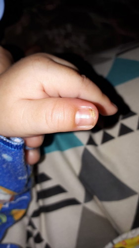 Obat luka untuk kuku bayi