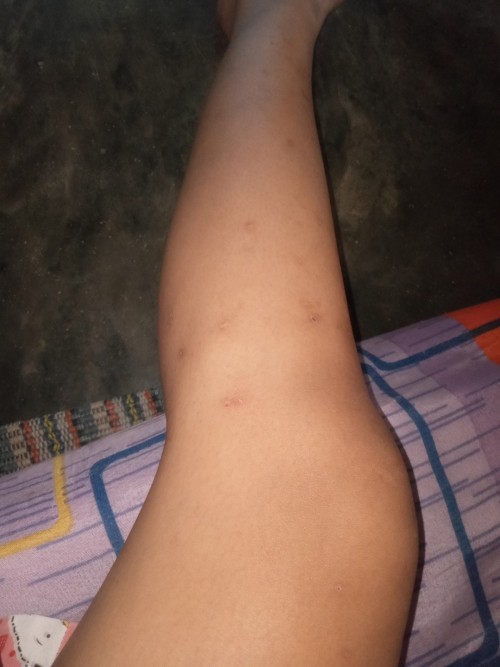 Gatal gatal