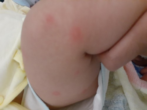 Cho em hỏi em bé gần 4 tháng mà nổi như này bị gì ạ?chỉ nổi ở chân trái thôi ạ