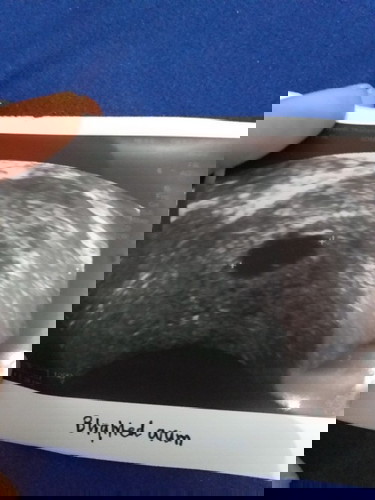 ท้องลมคะ