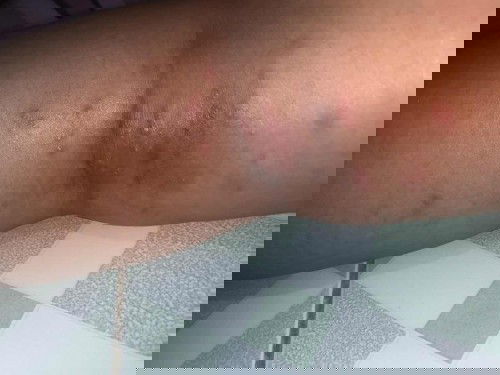 คันข้อพับขาด้านหลัง มีตุ่มขึ้น